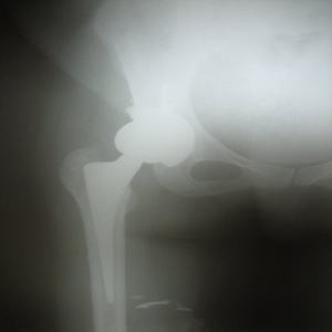 Hip Arthritis Uncemented Replacement